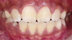 El Síndrome Periodontal No Carioso