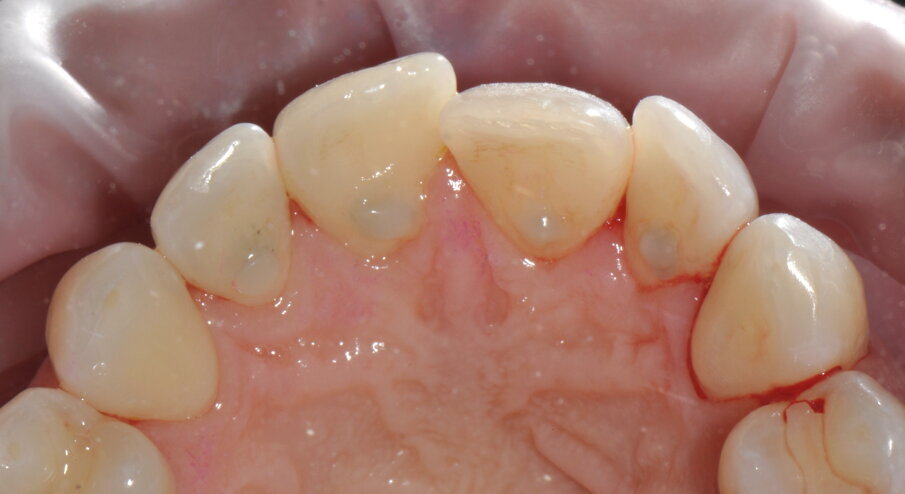 Figg. 3a-3c - Termine della terapia. nelle visioni vestibolare (3a), palatale (3b) e linguale (3c).