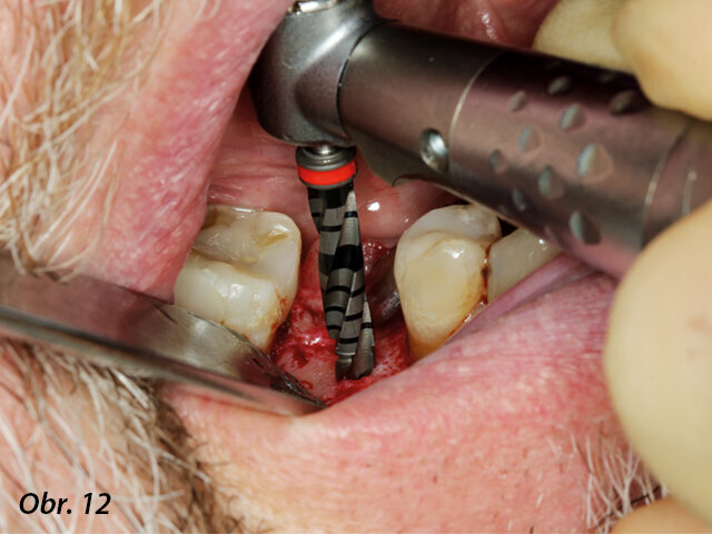 Osteotomie vrtákem průměru 3,5 mm.