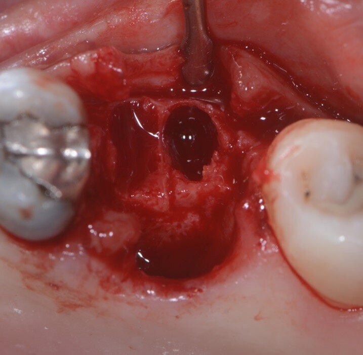 Fig. 4 - Corticale vestibolare esposta.