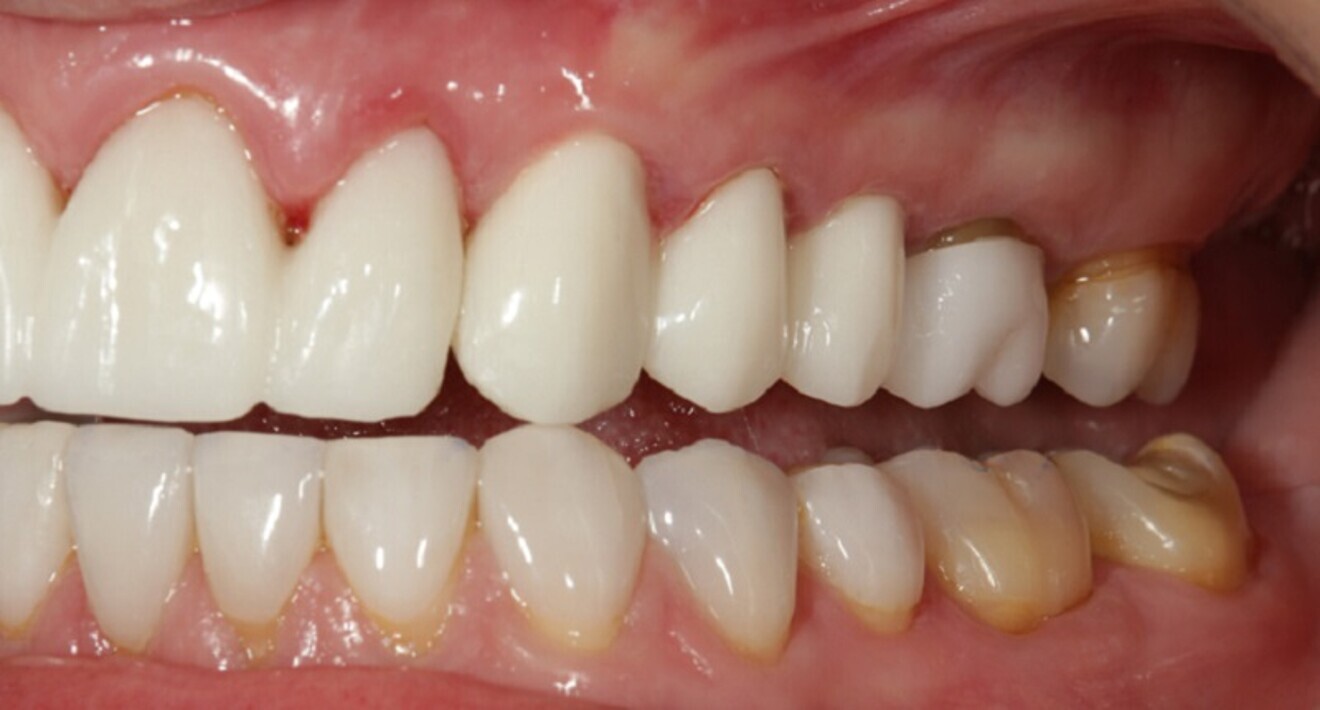 Fig. 17: Anterior guidance and canine disclusion were shown in the left working movement, displaying separation of all posterior teeth.