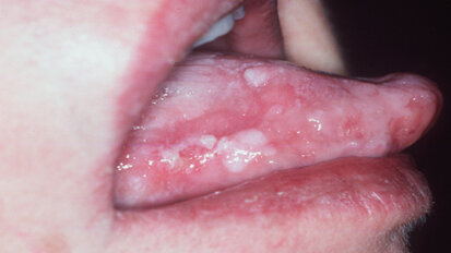 Nel cancro orale  la chiave del successo è nella diagnosi precoce e questa è affidata all’odontoiatra