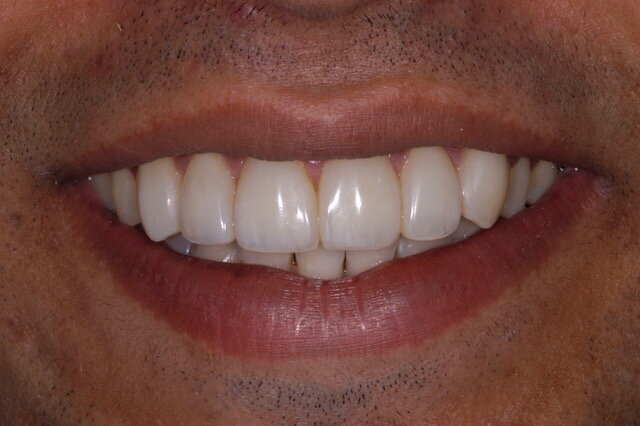 Fig 2B: Frontal smile view: After