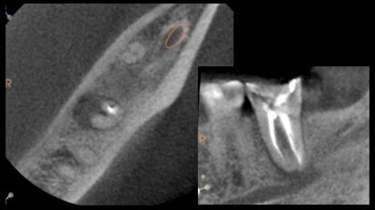 Técnica de Reimplante Intencional Digital para salvar dientes