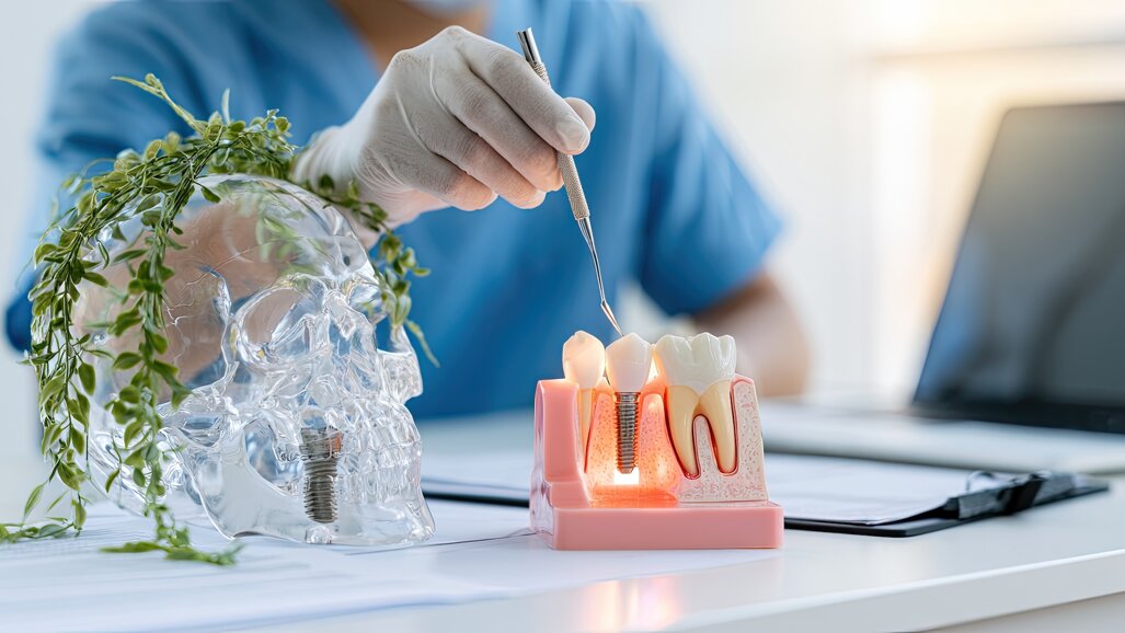“Understanding patterns of peri-implant bacterial colonisation is fundamental to preventing progression to peri-implant mucositis”