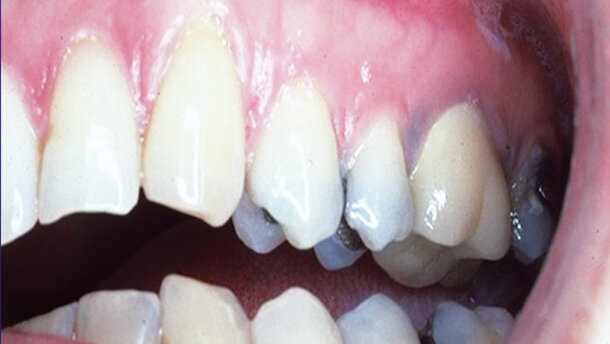 Root recession: Aesthetic and predictable elimination