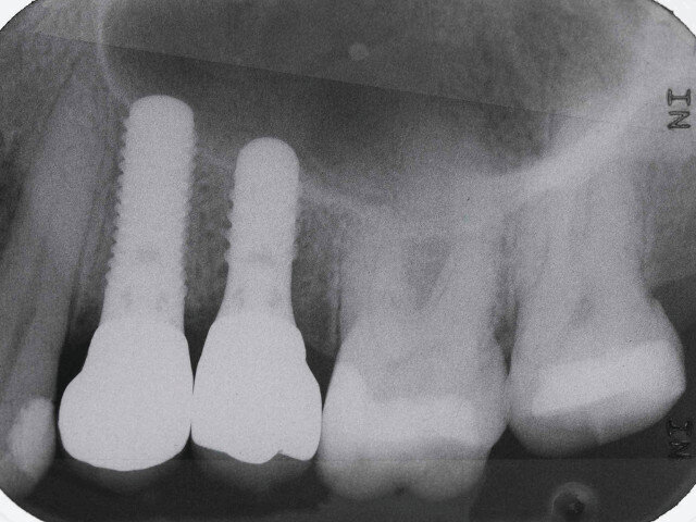 Fig. 14: Implant radiograph