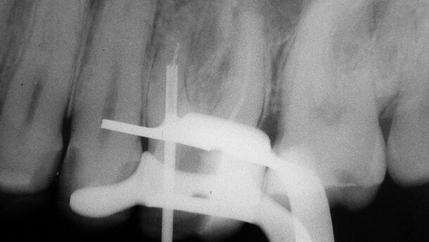 Retrait d’un instrument fracturé : nouvelle approche