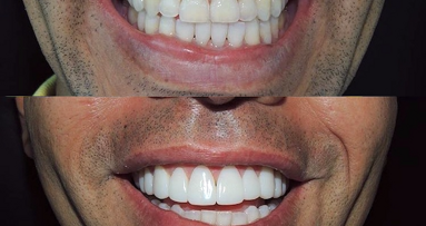 ¿Existe realmente el Diseño de la Sonrisa?