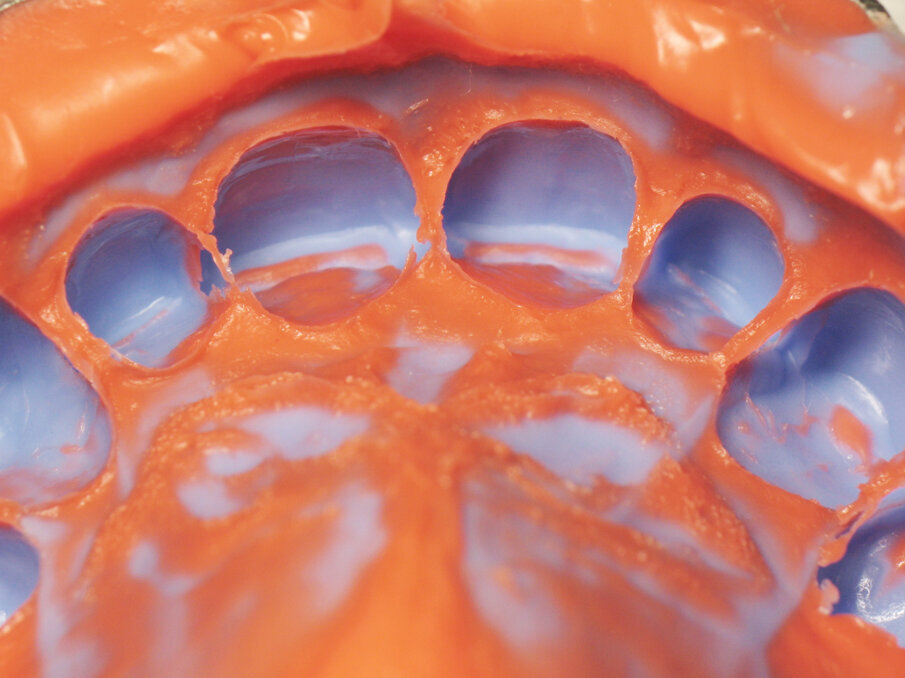 Fig. 3: V-Posil impression.