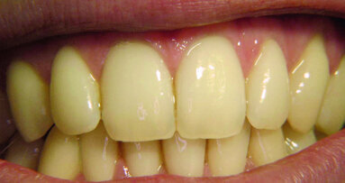 Ce que nos dents disent de nous — Partie I