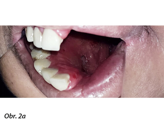 Zrcadlový intraorální pohled odhalující chirurgické odstranění levé části maxily, sahající až do nosního septa