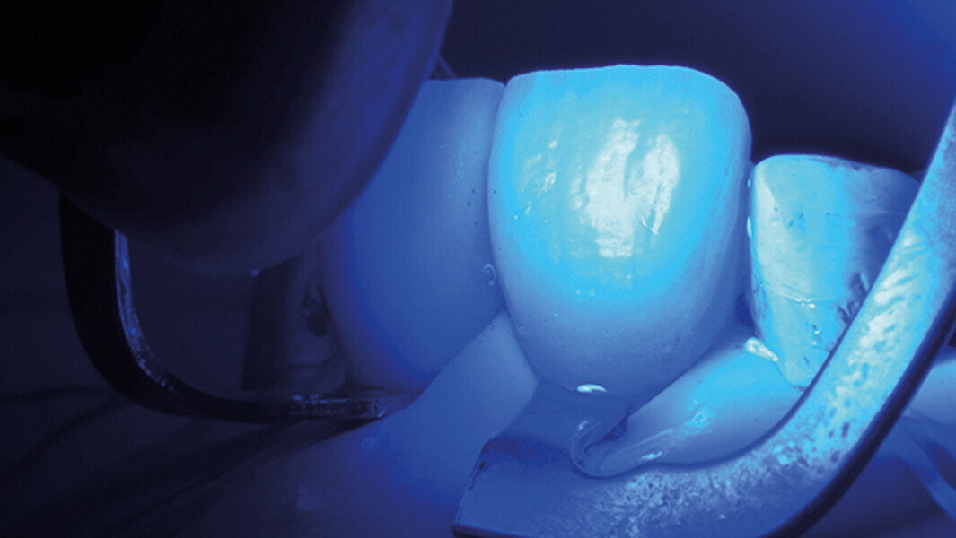 Fig. 16d. Polimerización final de las carillas.