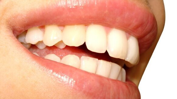 Mikroabrazja sposobem na rozjaśnienie uśmiechu