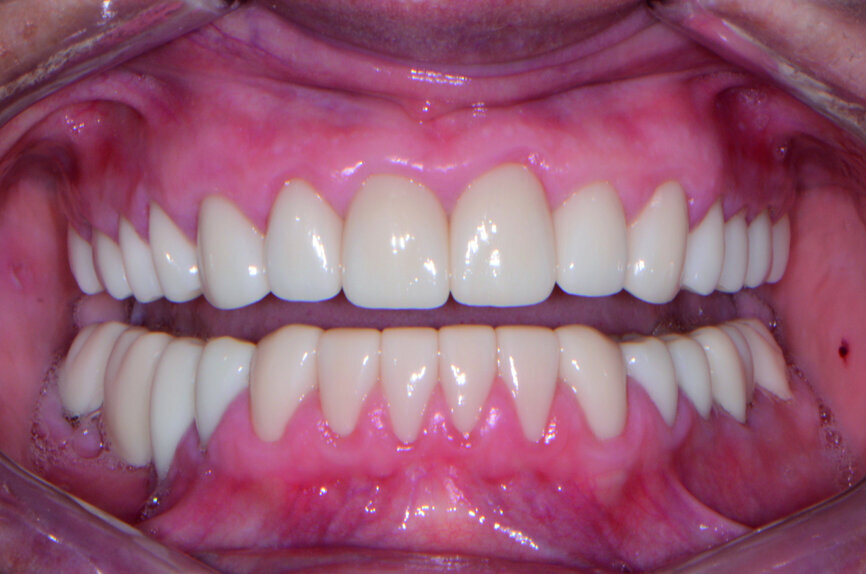 Fig. 10: Post-op retracted view.