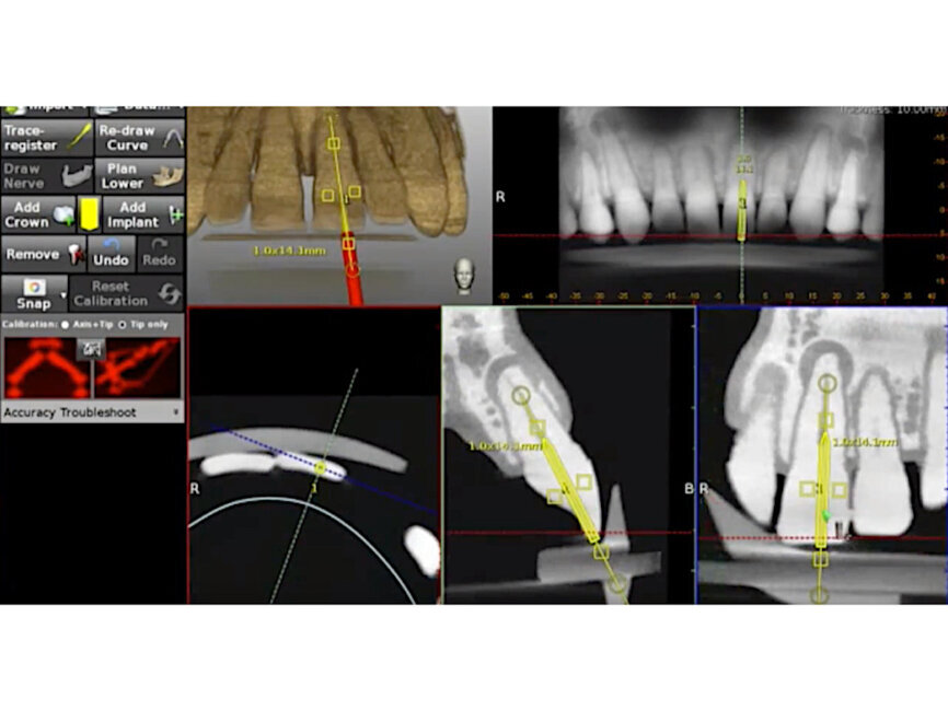 Fig. 4a: The planned axis angulation and orientation of the virtual drill are exacting in targeting calcified canals. (Courtesy of Dr Bobby Nadeau)