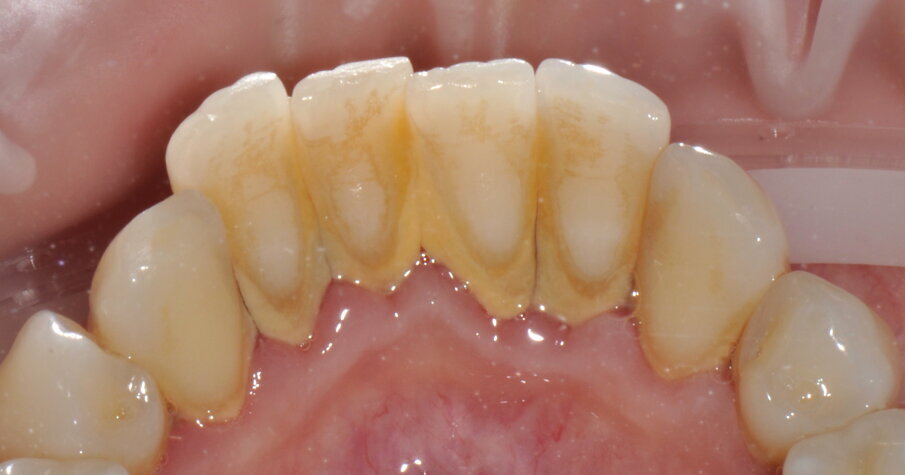 Figg. 4a-4f - Confronto fra inizio e termine della terapia. Le immagini (4a-c) mostrano le aree vestibolare palatale e linguale prima della terapia, mentre le immagini (4d-f) mostrano le aree vestibolare palatale e linguale dopo della terapia.