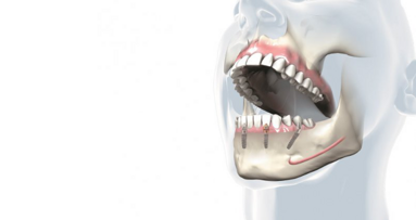 Novi materijali kao izbor pri izradu implantnih rekonstrukcija