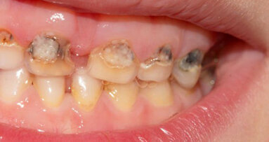 I batteri orali delle madri possono provocare carie nei loro figli