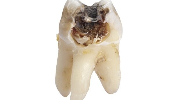 Polacy wciąż niechętnie chodzą do dentysty
