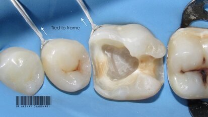 Rubber dam- Ace the basics