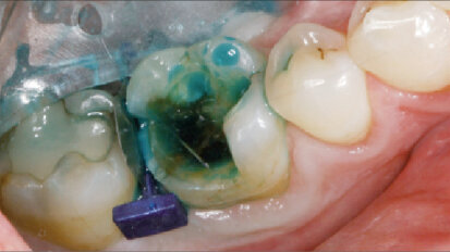 Korunka nebo onleje zhotovené v jeden den – ukázka klinického případu (Výhody nepřímých kompozitních náhrad)