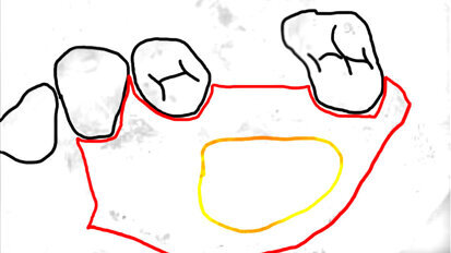 Kontrowersje wokół zabiegu podniesienia dna zatoki szczękowej od strony podniebiennej