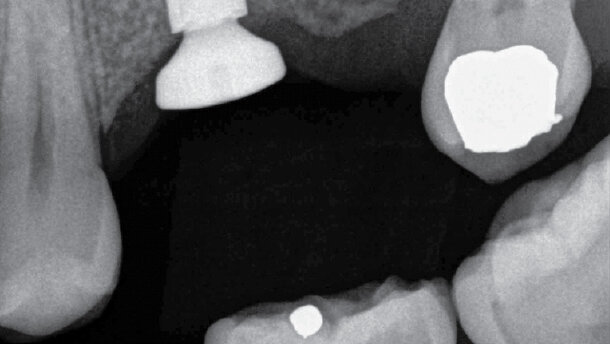 Endodonticko – implantologický algoritmus