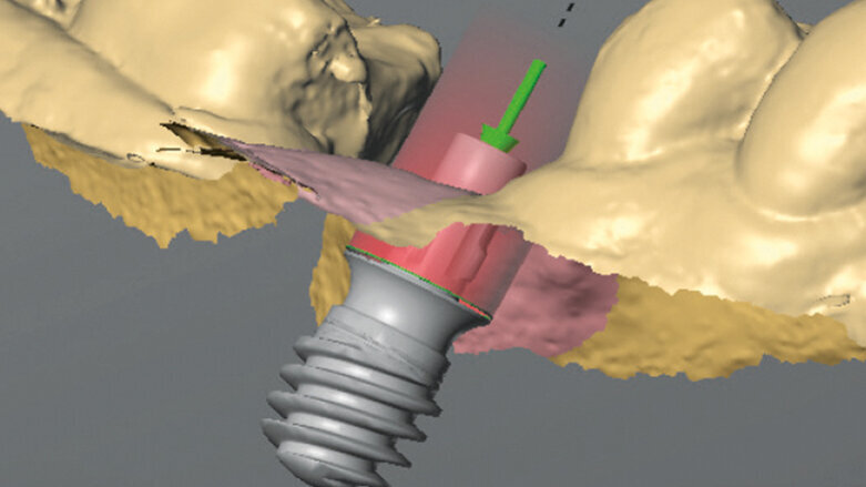 Náhrada zubu v jediné návštěvě: technika One-Tooth One-Time
