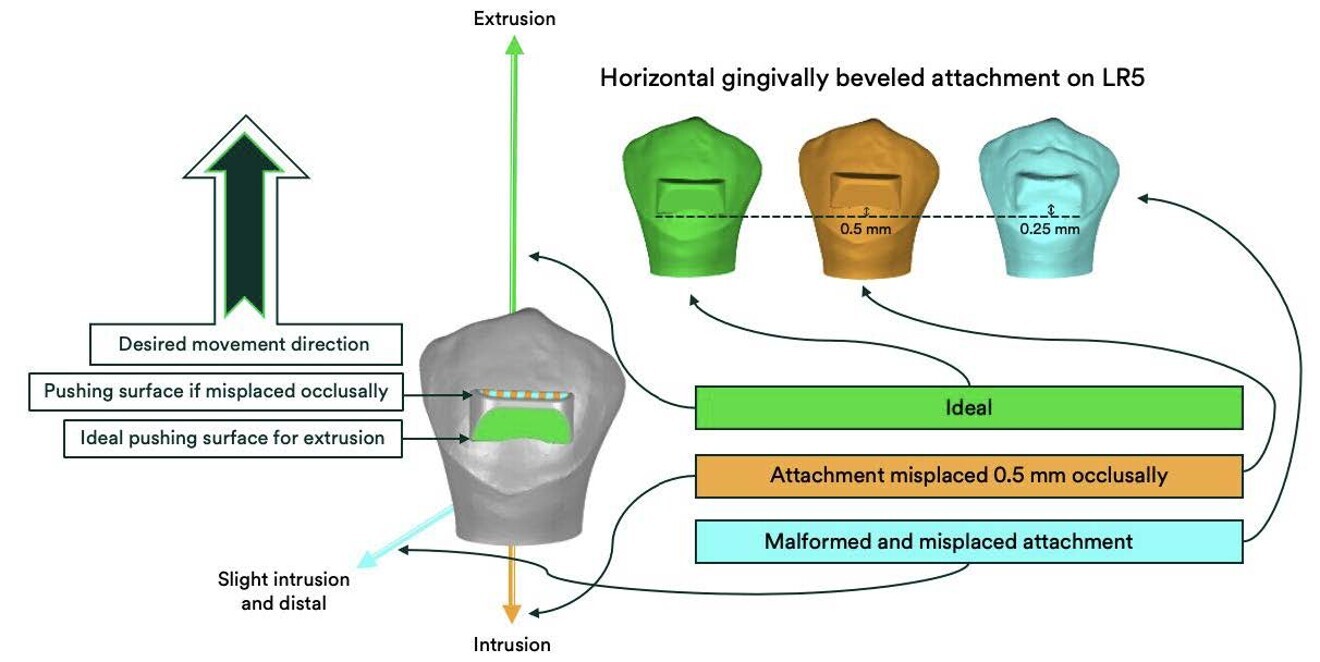 Fig. 4: Simulations of the force vectors obtained when horizontal gingivally bevelled attachments on tooth #45 are misplaced or malformed and misplaced. The green attachment achieves the desired force vector (green arrow). The orange attachment is misplaced 0.5 mm occlusally, resulting in a force vector in the opposite direction (orange arrow) of the desired force vector. The teal attachment is misplaced and has significant flash, resulting in a force vector in the incorrect direction (teal arrow).