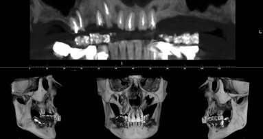 Conservazione del processo alveolare con sostituto osseo di origine equina a lento riassorbimento