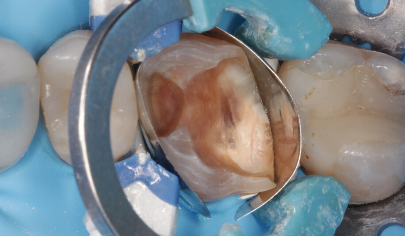 Fig. 11: Different matrix ring placed in the distal area. (Image: Kuraray Noritake Dental)