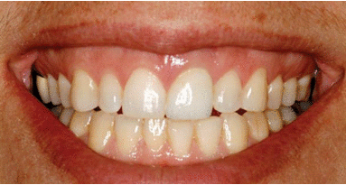 La dentisterie restauratrice basée sur l'implant : le futur, c'est maintenant !