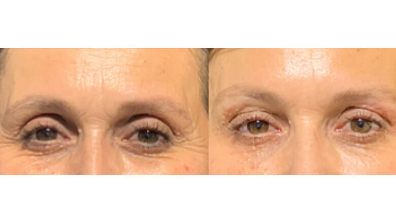 Foto 7. Mejora del aspecto de ojo hueco por relleno de ácido hialurónico del compartimento ROOF palpebral.
