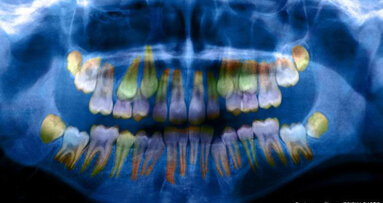 Stress levels are reflected in teeth