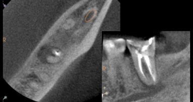Técnica de Reimplante Intencional Digital para salvar dientes