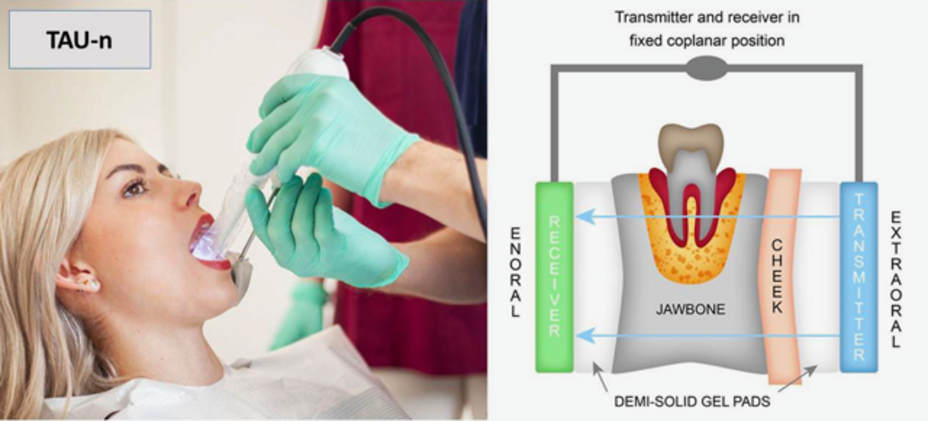 Fig. 3 : Appareil CaviTAU et représentation schématique de sa pièce à main.