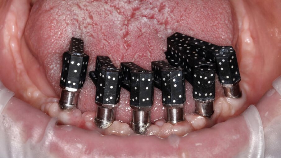 Fig. 3_Scan abutment codificati, appositamente progettati, vengono utilizzati per trasferire con precisione la posizione degli impianti al tecnico di laboratorio tramite fotogrammetria intraorale all’avanguardia, in questo caso per un’arcata mandibolare.