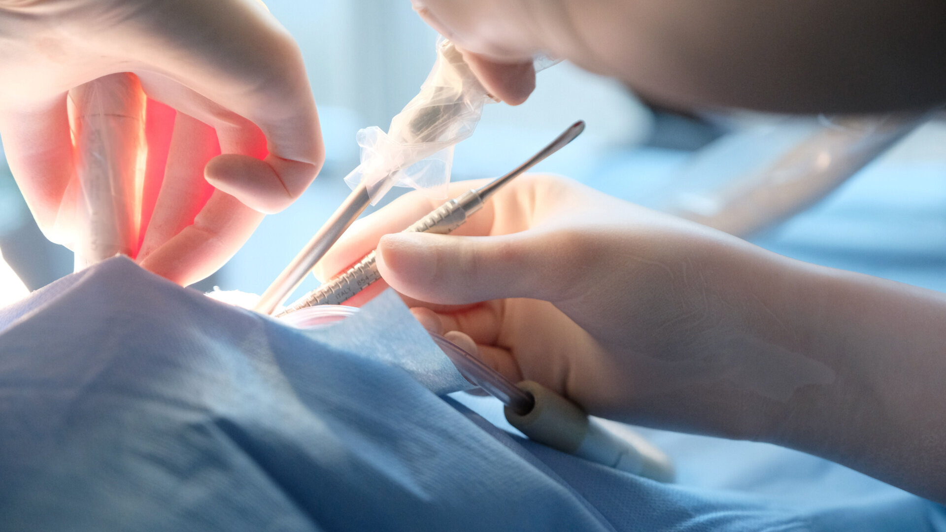 Single-session endodontic and surgical approach to internal root resorption: A long-term case report