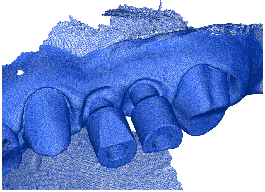 Fig. 4_Scansione intraorale: tunnel mucoso ormai collassato.