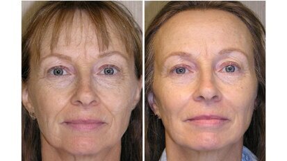 Improving the facial balance in an adult using slow arch development techniques Improving the facial balance in an adult using slow arch development techniques