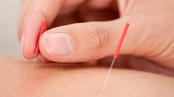 Nadeln gegen Würgereflex bei Abdrucknahme