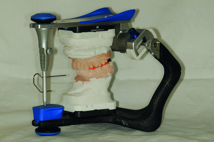 Fig. 26: Mounting of the mandibular model according to ICP bite registration.