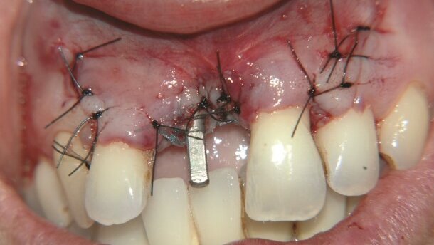 Rehabilitacja trudnego przypadku u pacjentki dotkniętej chorobą przyzębia w oparciu o implantację natychmiastową