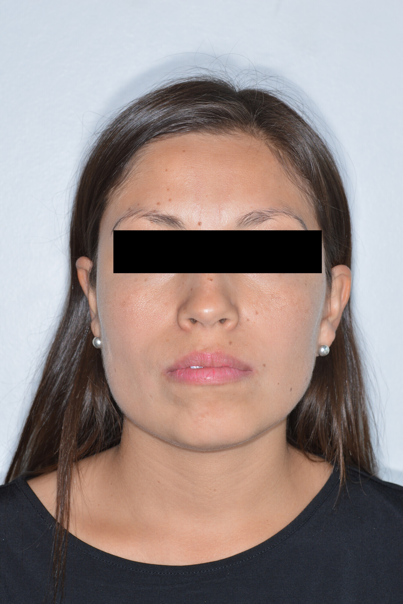 Fig. 1a: Initial extra-oral photographs.