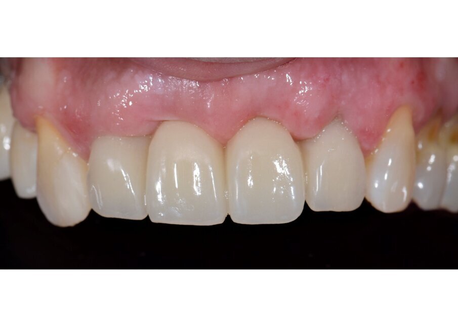 Fig. 65 - Controllo del provvisorio a una settimana.