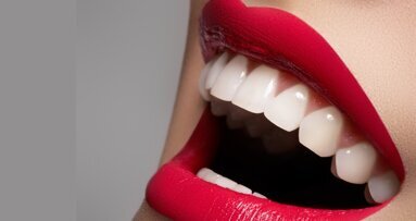 3 fakty na temat licówek