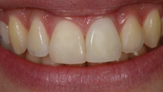 Stratification simplifiée en composite réalisée sous éclairage albédo LED D65 et sans scialytique