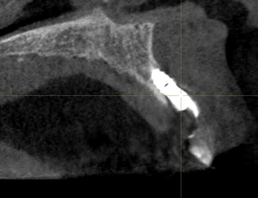 Fig. 2 - Tac che evidenzia la vestibolarizzazione dell’impianto.