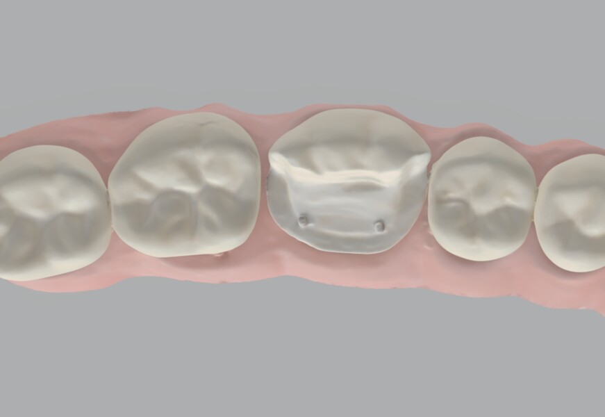 Fig. 14a: Scanned pinlay preparation on tooth #36 exported as a PLY file. 